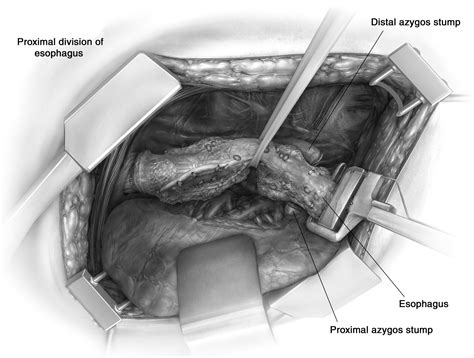 Technique of Open Ivor Lewis Esophagectomy - Operative Techniques in Thoracic and Cardiovascular ...