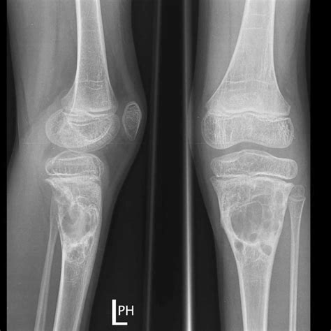 Lump On Tibia Bone