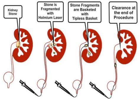 Kidney Stone Treatment in Bandra, Mumbai - Painless Kidney Stone ...