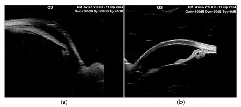 Unilateral Reverse Pupillary Block Associated with Multiple Ciliary ...