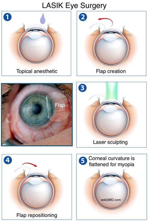 Lasik New Jersey Laser Eye Surgery Nj Cornea Eye
