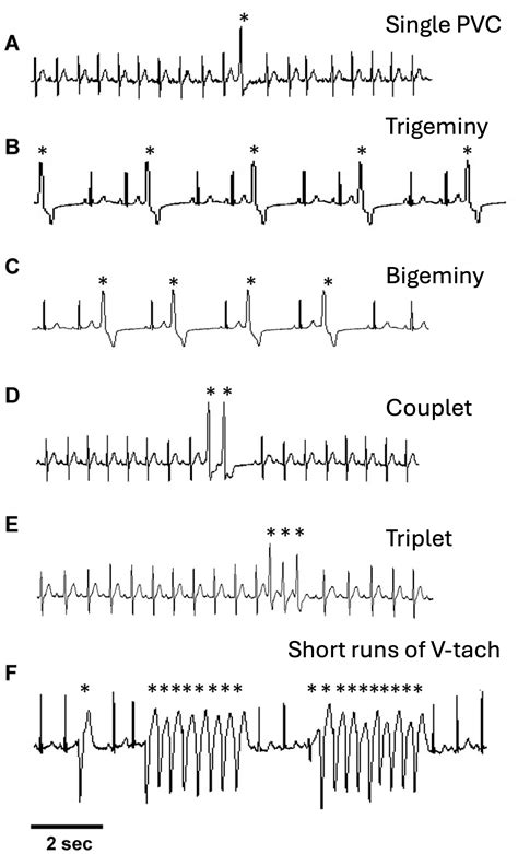 Unifocal Premature Ventricular Contractions