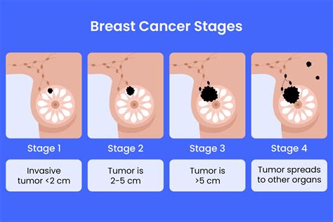 What Is Cancer Of The Breast