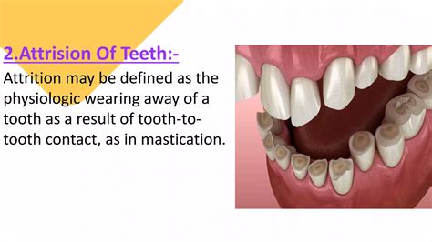 ATTRITION OF TEETH (Regressive Alterations of Teeth) | PPTX