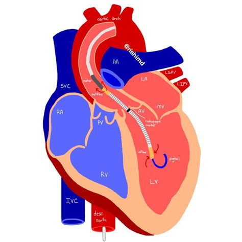 Pacemaker Procedure 的图像结果