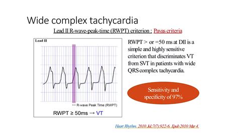 Image result for Wide Complex Tachycardia Algorithm