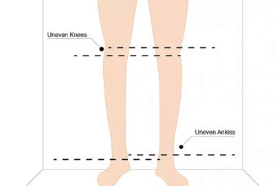 Measure Leg Length Discrepancy 的图像结果