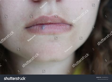 977 Swelling Lips Images, Stock Photos & Vectors | Shutterstock