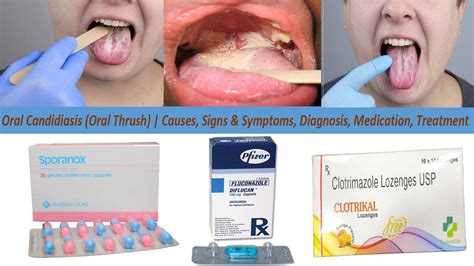Oral Candidiasis (Oral Thrush) | Causes, Signs & Symptoms, Diagnosis ...