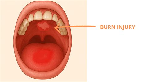 Burned the Roof of Your Mouth? Simple & Safe Tips for Fast Healing