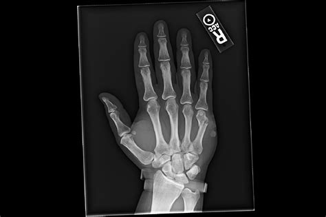 X Ray Broken Finger