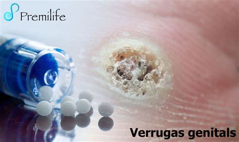 Verrugas genitals | Premilife - Homeopathic Remedies