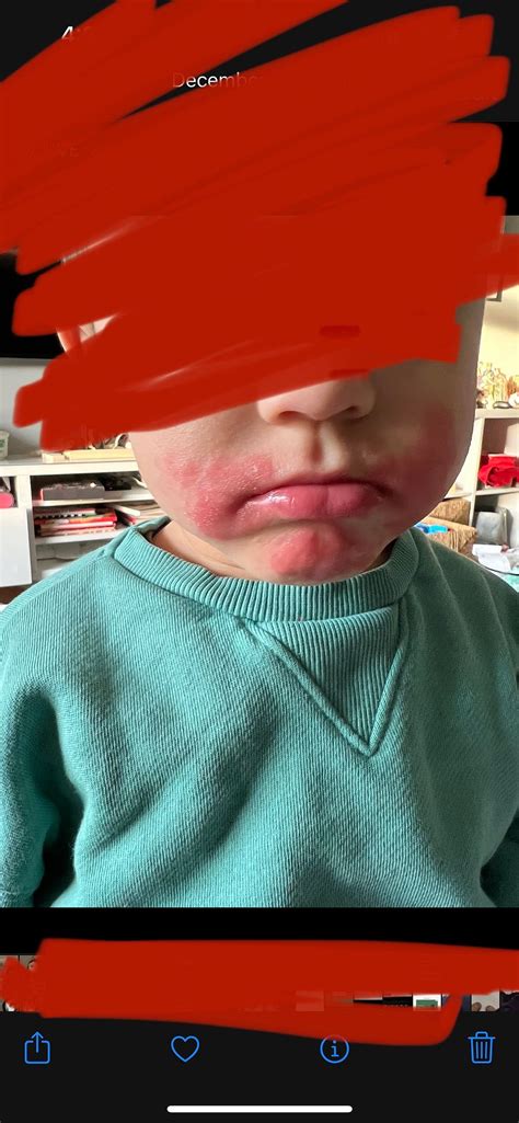 Perioral Dermatitis - Babies and Kids | BabyCenter