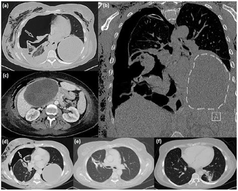 Diseases | Special Issue : Infectious Disease Epidemiology 2023