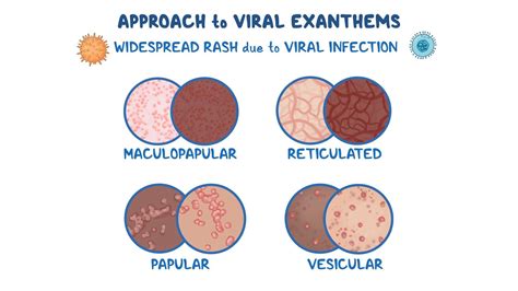 Video: Approach to viral exanthems (pediatrics): Clinical sciences ...