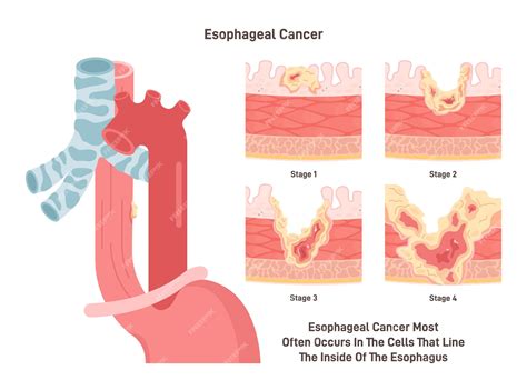 Premium Vector | Esophageal cancer malignant inflammation of esophagus wall cells tissues of the ...