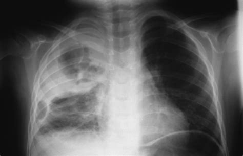 Can A Chest X Ray Show Pneumonia at Elizabeth Chow blog