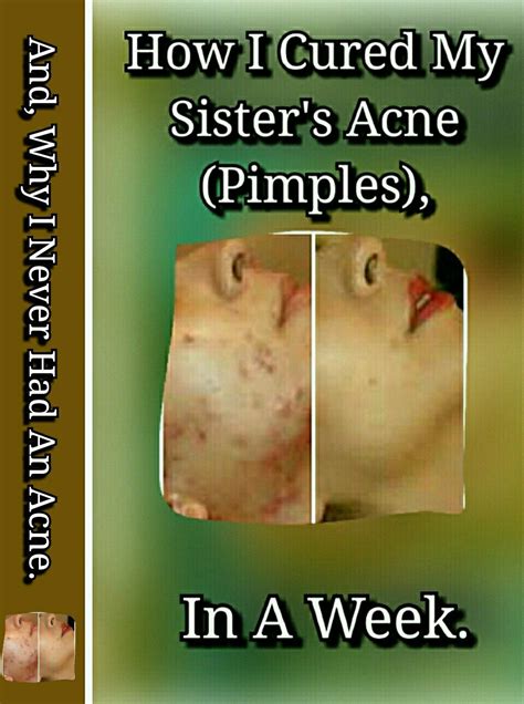 How I cured my sister's Acne ( pimples ) in a week: And why I never had ...