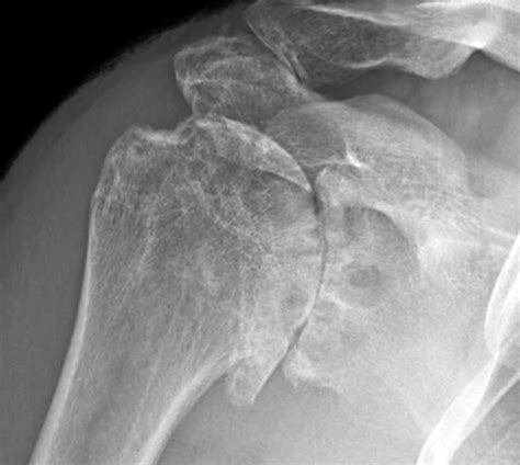 UW Shoulder and Elbow Academy: Shoulder joint replacement - many different types of arthritis