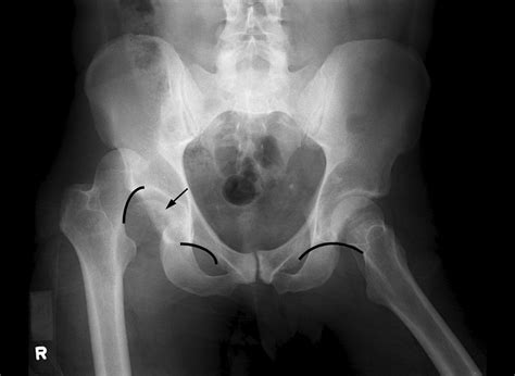 Impacted Fracture Femur