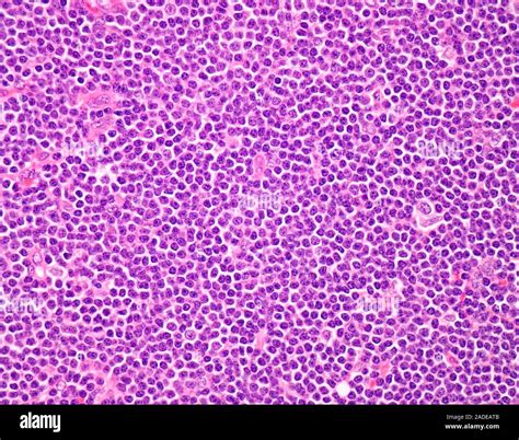 Small Cell Lymphoma