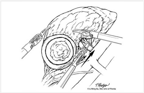 Image result for Robotic Partial Nephrectomy Video Animation