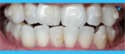 Invisalign Buttons 的图像结果