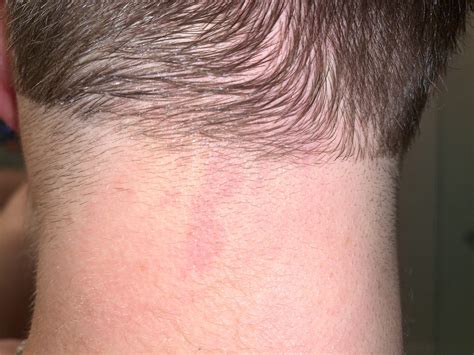 Rash on back of neck : r/medical