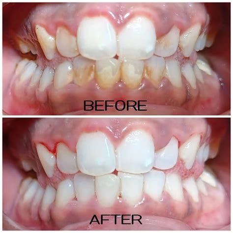 Tartar cleaning - before and after | Tartar removal, Tartar, Dental whitening