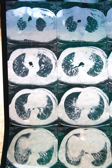 End Stage of Emphysema 的图像结果