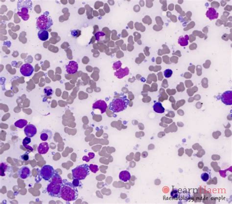 dlbcl | dlbcl 肝臓 – XOIJO