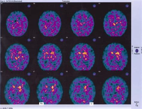 Image result for Dat Scan Utube