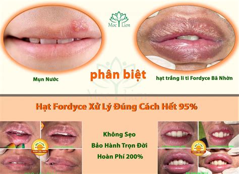 Hạt Fordyce ở môi và cách điều trị