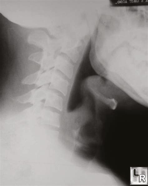Epiglottis Thumbprint Sign