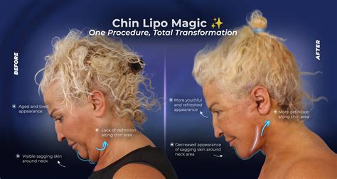 What is Chin Lipo? The Complete Beginner's Guide | Estherian Clinic