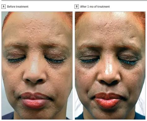 Ruxolitinib found efficacious in patient with severe lupus miliaris ...