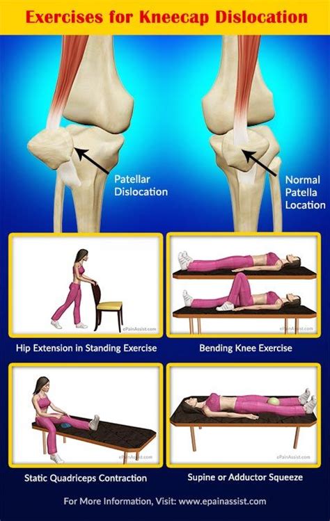 Image result for Patellar Dislocation Exercises