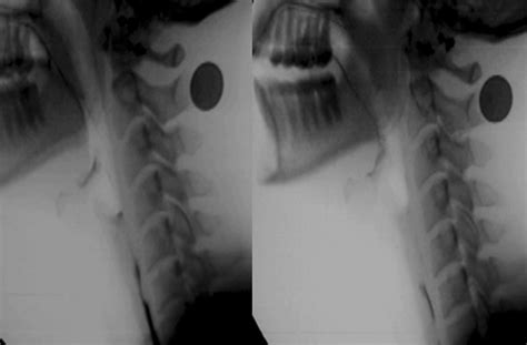Image result for Modified Barium Swallow Video Example