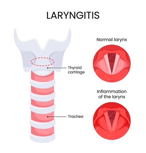 Premium Vector | Diagram of laryngitis infection disease