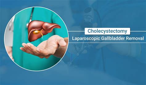 Open Cholecystectomy 的图像结果