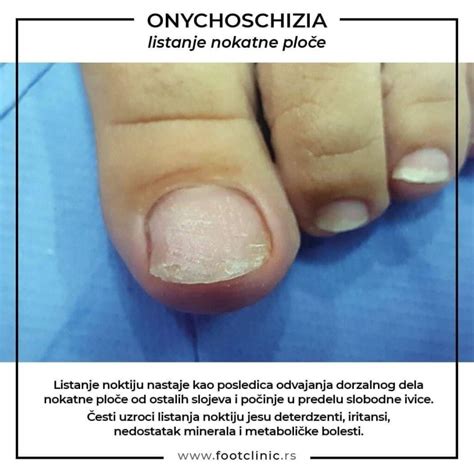 Atletsko stopalo prouzrokuju različite gljivice | Footclinic M&S