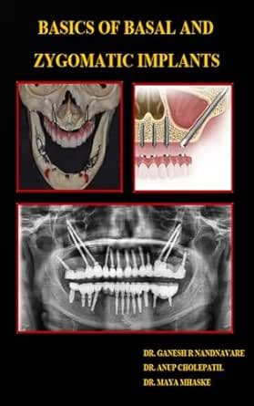 BASICS OF BASAL AND ZYGOMATIC IMPLANTS eBook : R NANDNAVARE, DR. GANESH ...