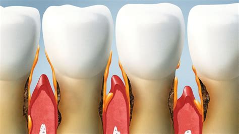 Image result for Gum Paste Pocketing