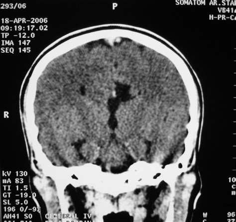 Image result for Scanner Cerebral Avec Injection Diode