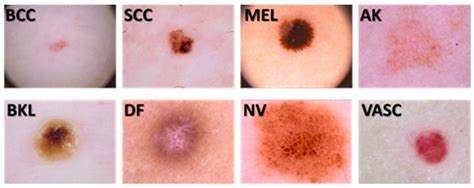 Hybrid Transform-Based Feature Extraction for Skin Lesion ...