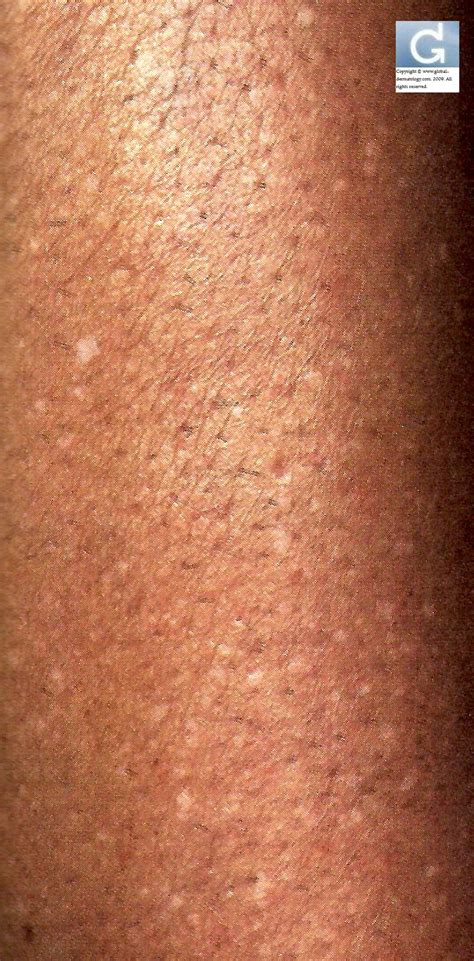 Global Dermatology » Idiopathic guttate hypomelanosis