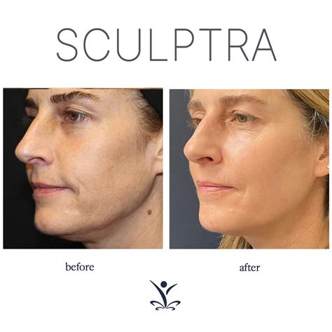 Sculptra Before And After Butt Lift