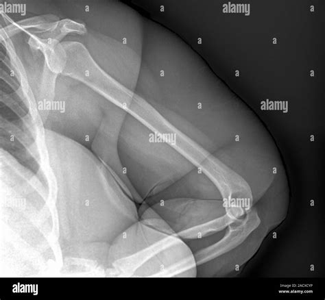 X-ray of the left arm (frontal view) of an obese 23 year-old woman, who ...