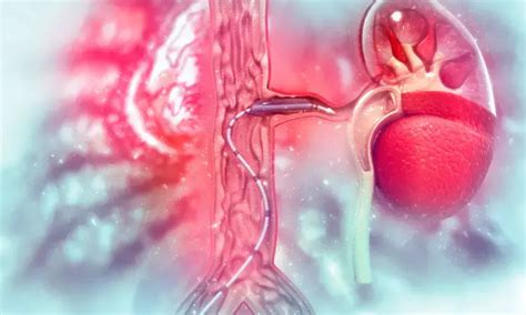 Intravascular lithotripsy effective option for severely calcified ...