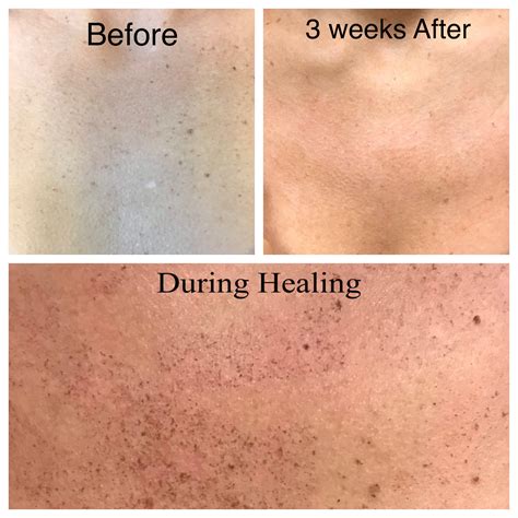 Sun Spot and Age Spot Removal - Dermatology Care of Charlotte